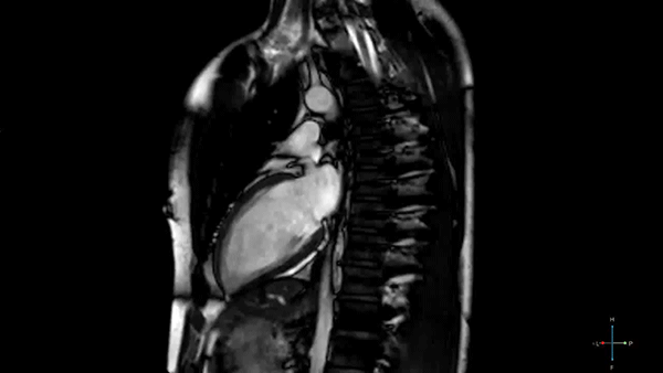 Cardiac MRI Scan